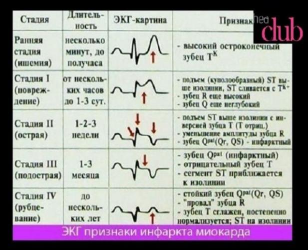 Первые признаки инфаркта у мужчин