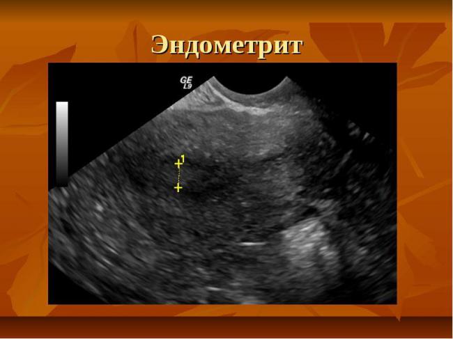 Эндометрит | симптомы | диагностика | лечение - docdoc.ru