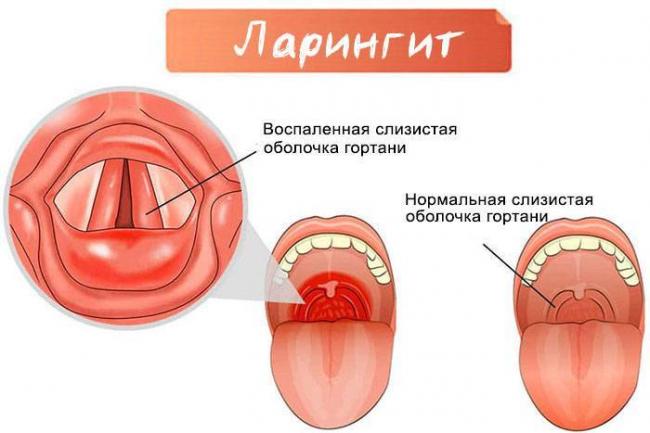 Ларинготрахеит: причины, симптомы, диагностика и лечение