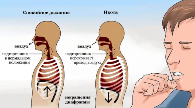 Как избавиться от икоты быстро в домашних условиях