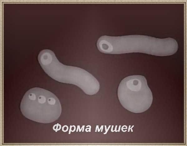 Деструкция и отслойка стекловидного тела