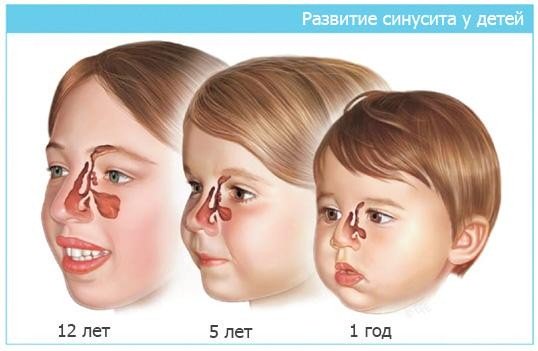 Симптомы гайморита у взрослых: