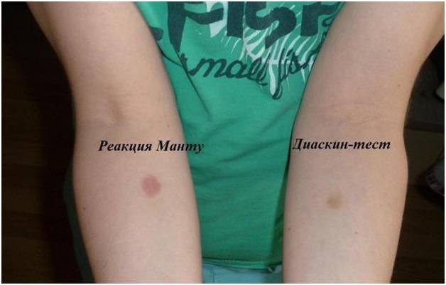 Диаскинтест при насморке: можно делать или нет