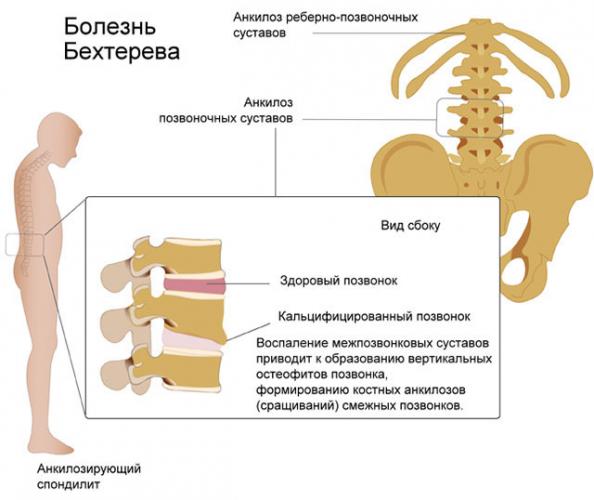 Спондилит поясничного отдела позвоночника: что это такое, симптомы и лечение воспаления