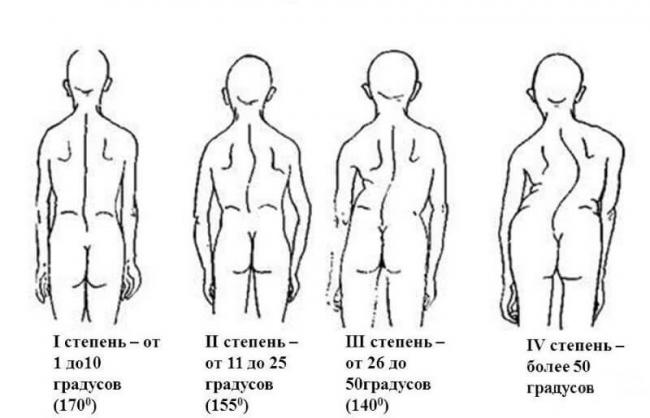 Лфк при кифозе грудного отдела позвоночника