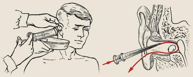 Боль в ушах при простуде: возможные причины и методы лечения