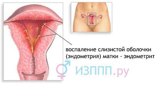 Микоплазменная пневмония: специфика заболевания