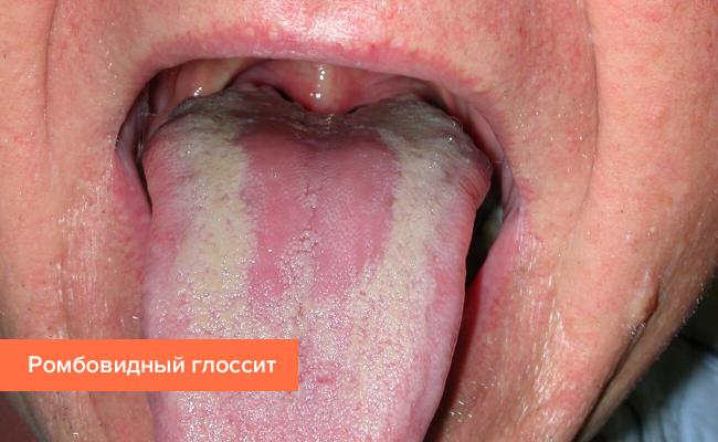 Глоссит: формы, симптомы и лечение народными средствами