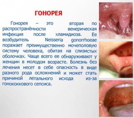 Гонорея