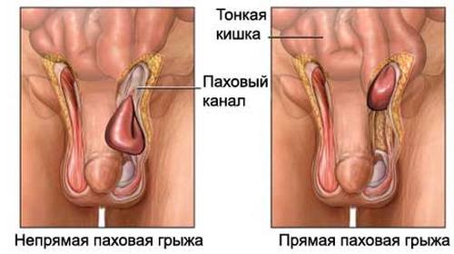 Паховая грыжа - симптомы, лечение, операция по удалению паховой грыжи
