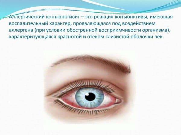 Эписклерит глаза: причины, симптомы и лечение заболевания препаратами детей и взрослых, код мкб-10