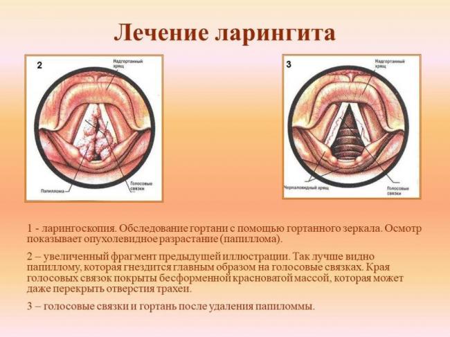 Ларинготрахеит