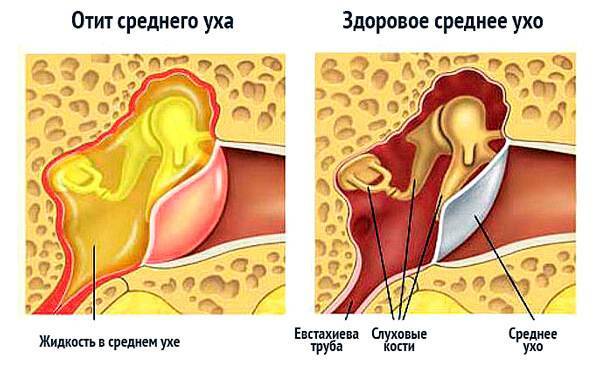 Что делать если заложило уши от насморка: причины и лечение