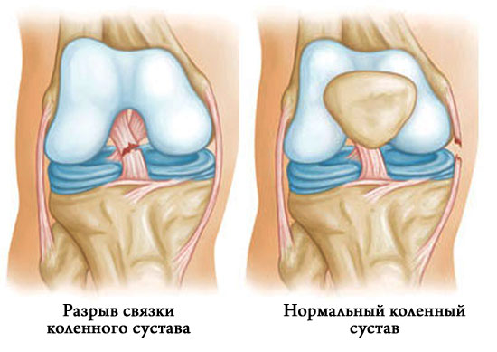 Растяжение связок колена — симптомы, лечение, первая помощь