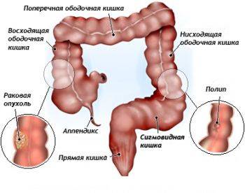 Бактериоз кишечника