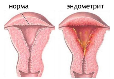 Эндометрит – острый и хронический. симптомы, причины, диагностика, лечение заболевания. :: polismed.com