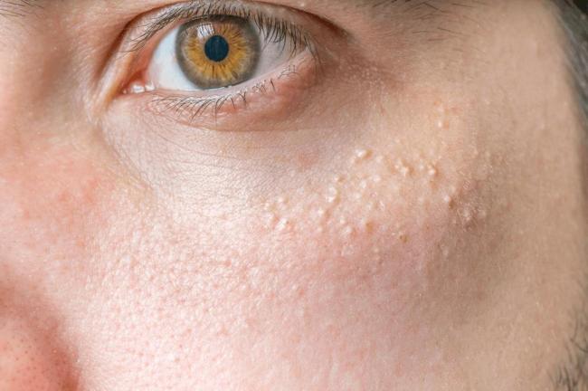 Удаление милиумов: преимущества, недостатки и противопоказания | food and health