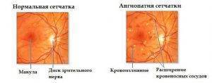 Ангиопатия сетчатки обоих глаз