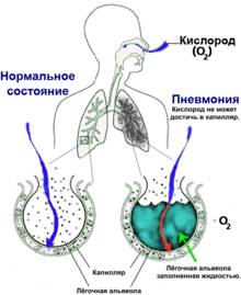 Какая температура при пневмонии у детей