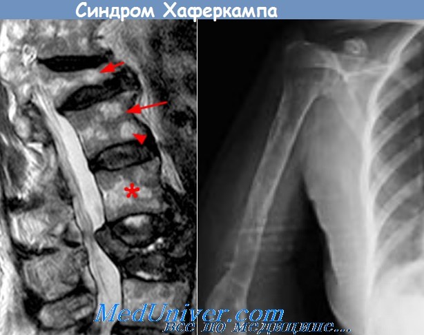 Синдром гийена-барре. что это, причины, симптомы, лечение, диагностика болезни