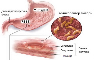 Какой лучше сдавать анализ хеликобактер пилори и какой из них точнее?