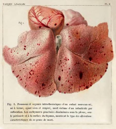 Асфиксия википедия