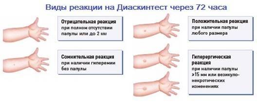Можно ли делать диаскинтест ребенку с простудой