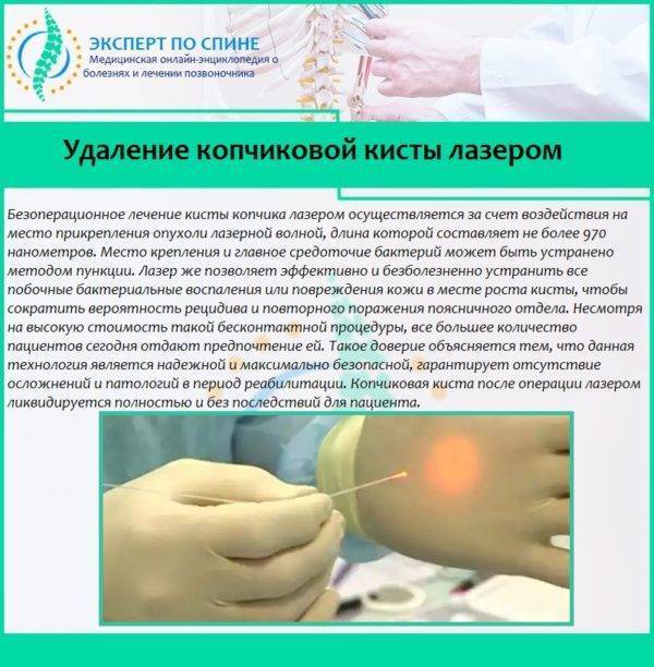 Киста копчика: симптомы и лечение у мужчин, как лечить без операции в домашних условиях
