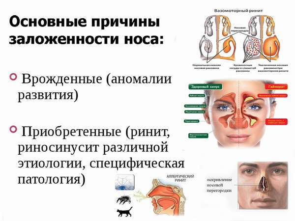 Комаровский: заложен нос, соплей нет у ребенка, чем лечить сильную заложенность носа