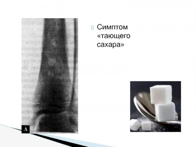 Спондилит поясничного отдела позвоночника