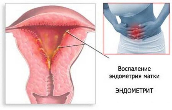 Эндометрит: симптомы и лечение у женщин