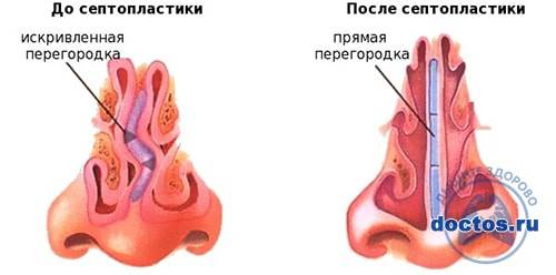Искривление носовой перегородки: опасные последствия
