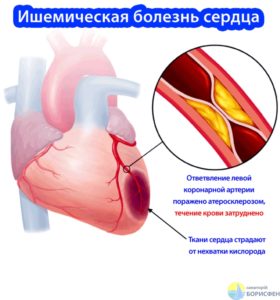 Лечебное питание при ишемической болезни сердца