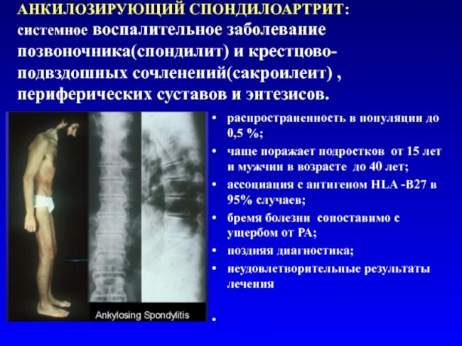 Классификация спондилита позвоночника и его лечение