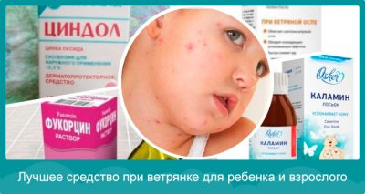 Помогает ли каламин лосьон при ветрянке?