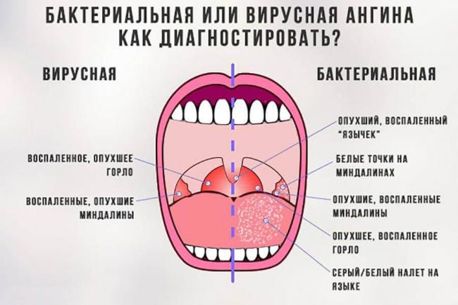 Схемы лечения хронического тонзиллита у взрослых