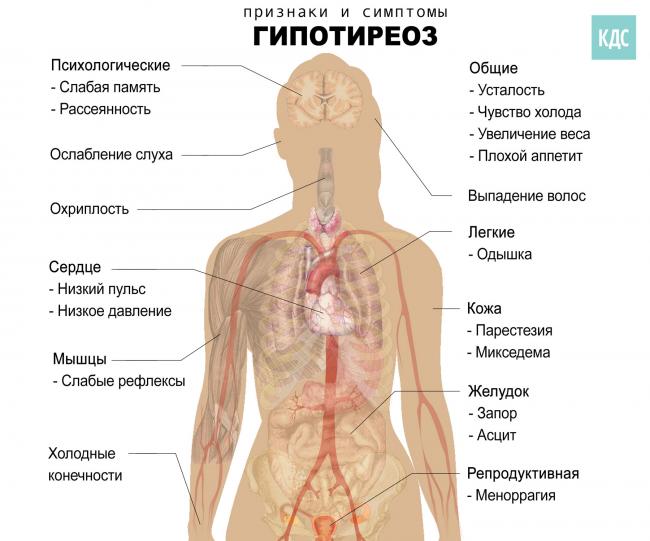 Причины возникновения микседемы щитовидной железы и её симптомы