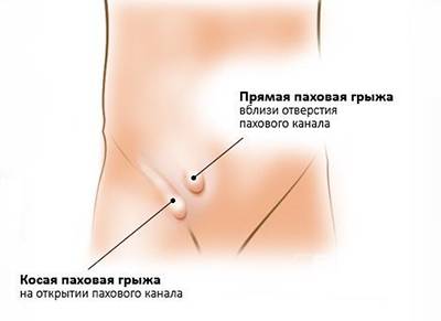 Паховая грыжа