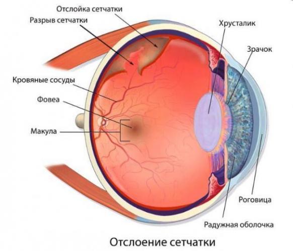 Скотома (темные пятна в поле зрения): что это такое?