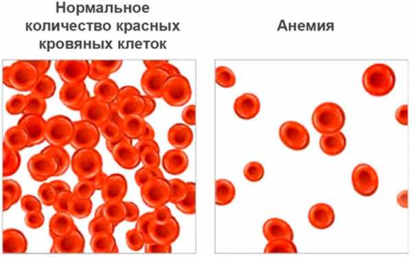 Низкая температура тела, причины, что делать?