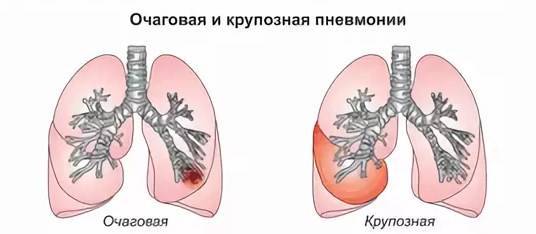 Пневмония