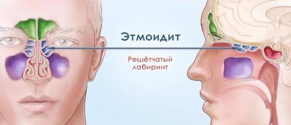 Воспаление клиновидной пазухи – симптомы и лечение в домашних условиях