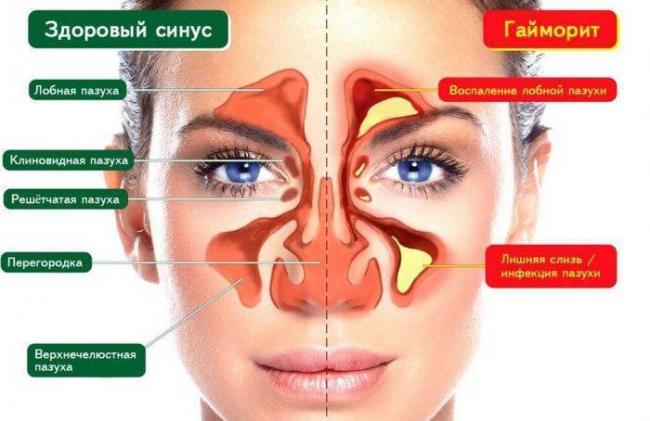 Психосоматические причины насморка, гайморита, синусита