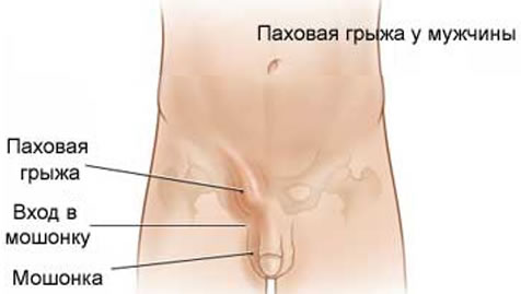 Почему возникает паховая грыжа, и нужно ли ее оперировать?