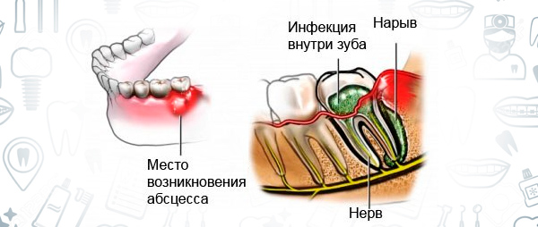 Как образуется гной. почему образуется гной? причины и виды нагноения. как лечить нагноение? видео: «как избавиться от прыщей»