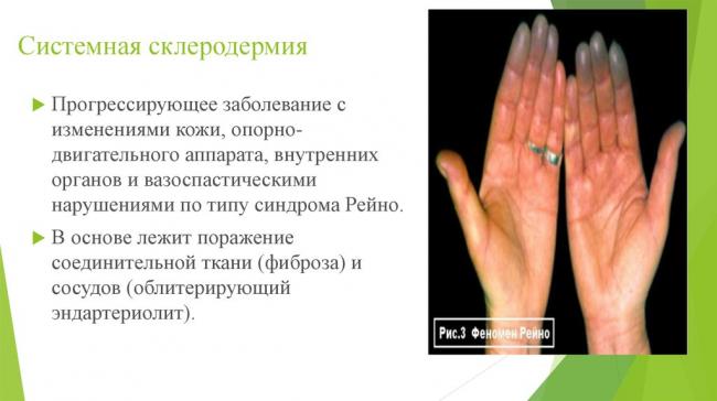 Склеродермия