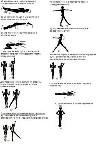 Лфк при кифосколиозе: восстанавливаем правильную осанку