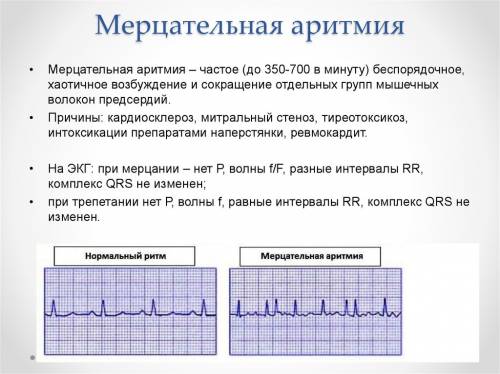 Аритмия: почему возникает и как лечить