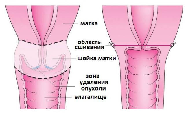 Заболевания шейки матки, лечение и профилактика