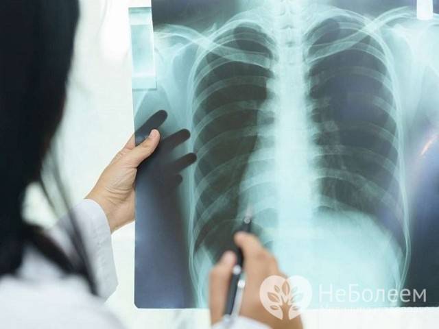 Лфк и дыхательная гимнастика при пневмонии: упражнения, которые помогут восстановиться